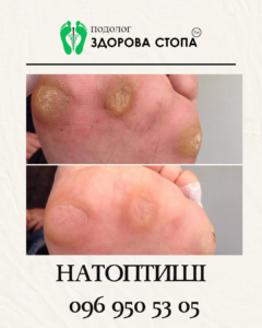 Лікування натоптишів
