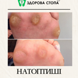 Лікування натоптишів