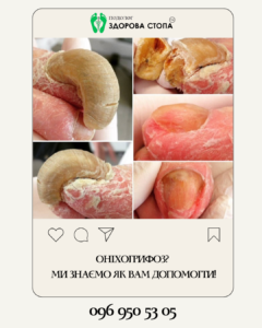 Лікування оніхогрифозу