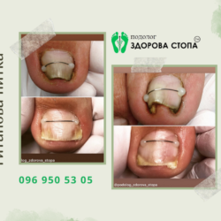 Видалення врослого нігтя
