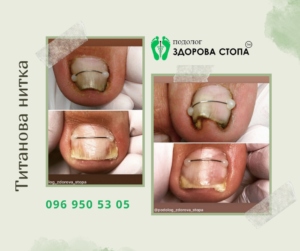 Видалення врослого нігтя