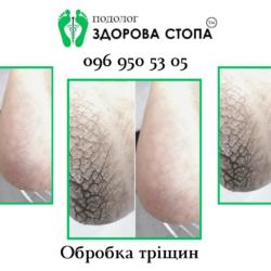 Тріщини на п'ятах