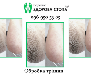 Тріщини на п'ятах
