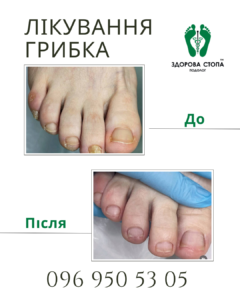 Комплексне лікування грибка