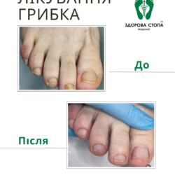 Комплексне лікування грибка