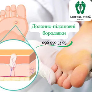 Підошовні бородавки