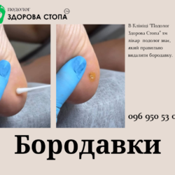 Видалення бородавок на стопі
