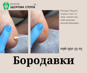 Видалення бородавок на стопі