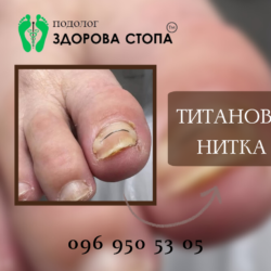 Лікування врослого нігтя титановою ниткою