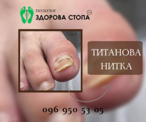 Лікування врослого нігтя титановою ниткою