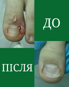 Врослі кути