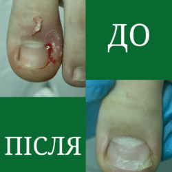 Врослі кути