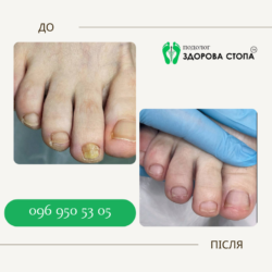 Лазерне лікування грибка