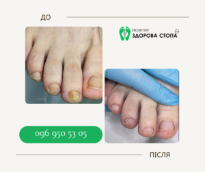 Лазерне лікування грибка