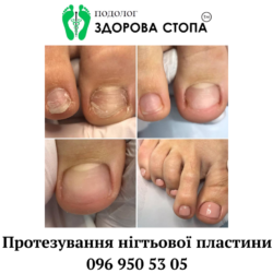 Протезування нігтьової пластини