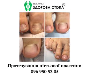 Протезування нігтьової пластини