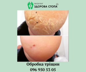 Лікування тріщин на п'ятах