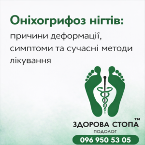 Лікування оніхогрифозу