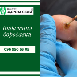 Видалення бородавок