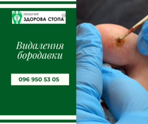 Видалення бородавок