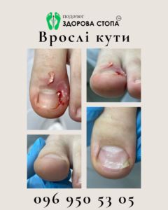 Чому вростають нігті?