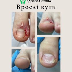 Чому вростають нігті?