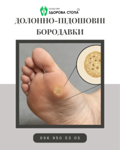 Долонно-підошовні бородавки