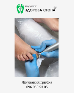 Комплексне лікування грибка