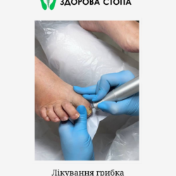 Комплексне лікування грибка