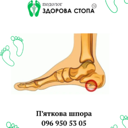 Лікування п'яткової шпори