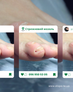 Стрижневий мозоль