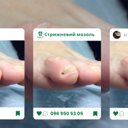Стрижневий мозоль