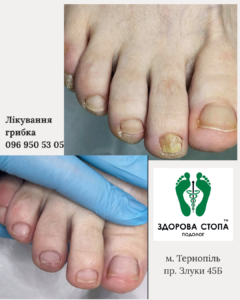 Лікування грибка