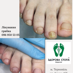 Лікування грибка