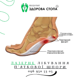 Лікування п'яткової шпори