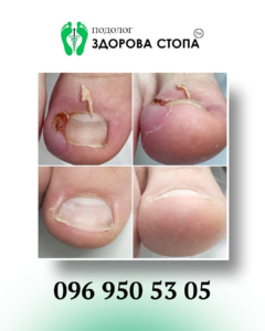 Врослі нігті
